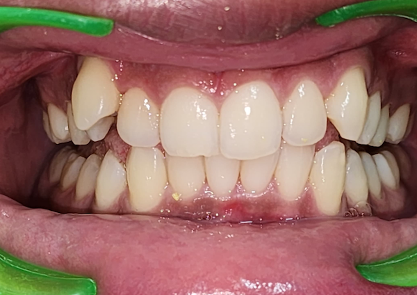 Teeth Straightening - Before